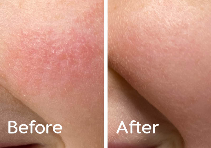 Before and After Eczema Treatment with Tight and Bright Sport Treatment